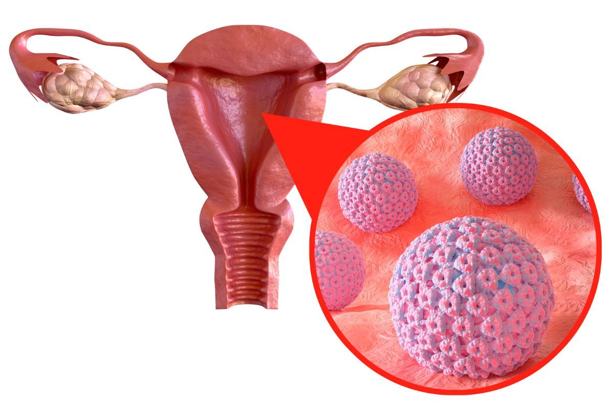 infeccao-hpv-dra-juliana-ribeiro-ginecologista-sao-paulo