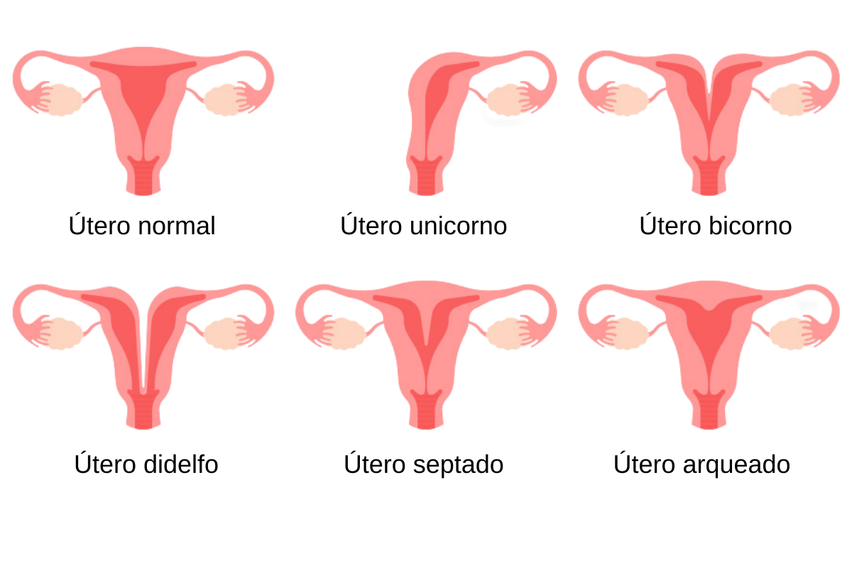 malformacao-utero-dra-juliana-ribeiro-ginecologista