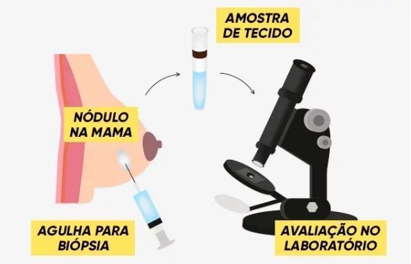 nodulo-mama-dra-juliana-ribeiro-ginecologista-sao-paulo