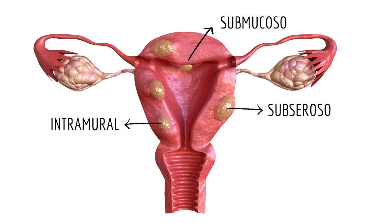 tipos-mioma-uterino-dra-juliana-ribeiro-ginecologista-sao-paulo