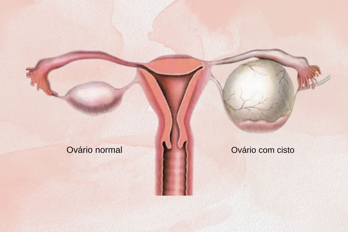 torcao-do-ovario-causas-dra-juliana-ribeiro-ginecologista-sao-paulo