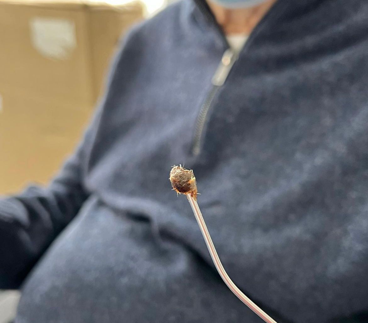 EAR WAX REMOVAL