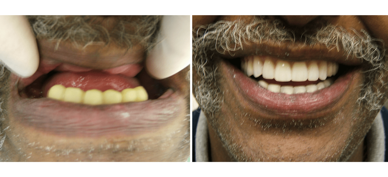 Dentures — Richmond, VA — Dr. Babik & Associates