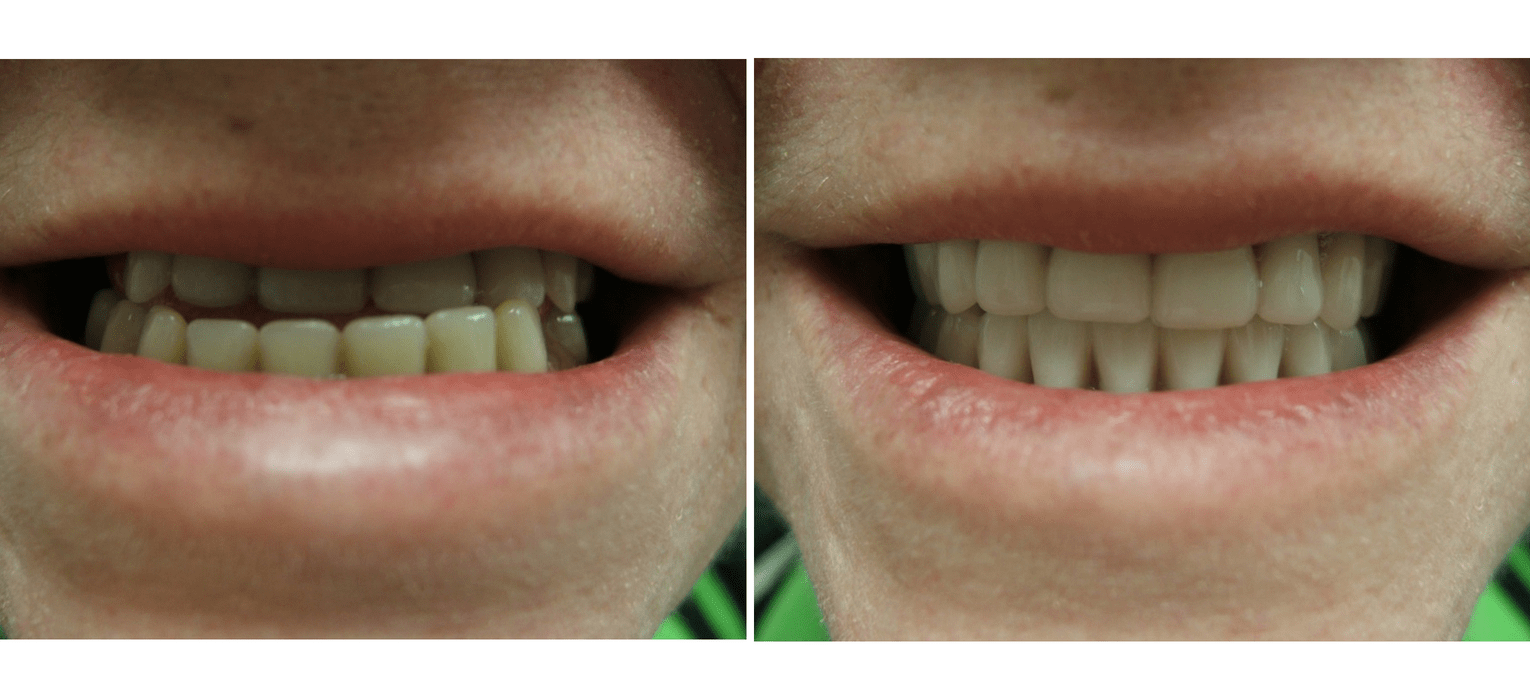 Before and After Dentures — Richmond, VA — Dr. Babik & Associates