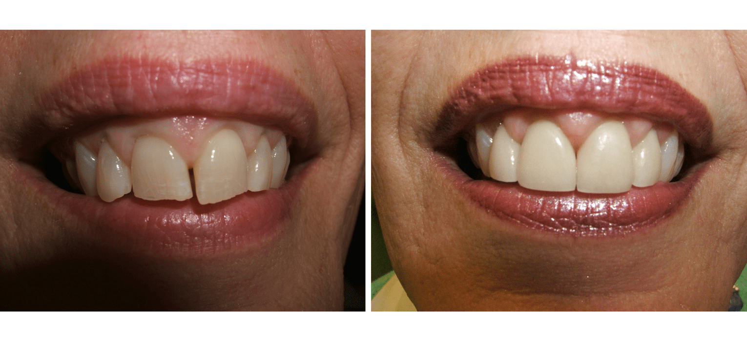 Before and After Dental Process — Richmond, VA — Dr. Babik & Associates