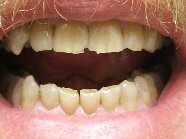 Teeth Grinding — Richmond, VA — Dr. Babik & Associates