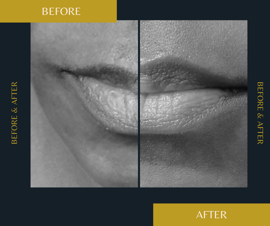 Before and after Lip flip