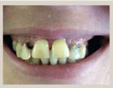 Before Dentures — Kokomo, IN — Family Practice
