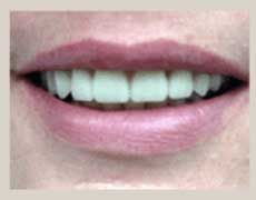 After Dentures — Kokomo, IN — Family Practice