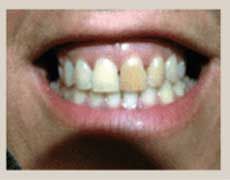 Before Dental Veneers — Kokomo, IN — Family Practice