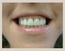 After Dental Veneers — Kokomo, IN — Family Practice