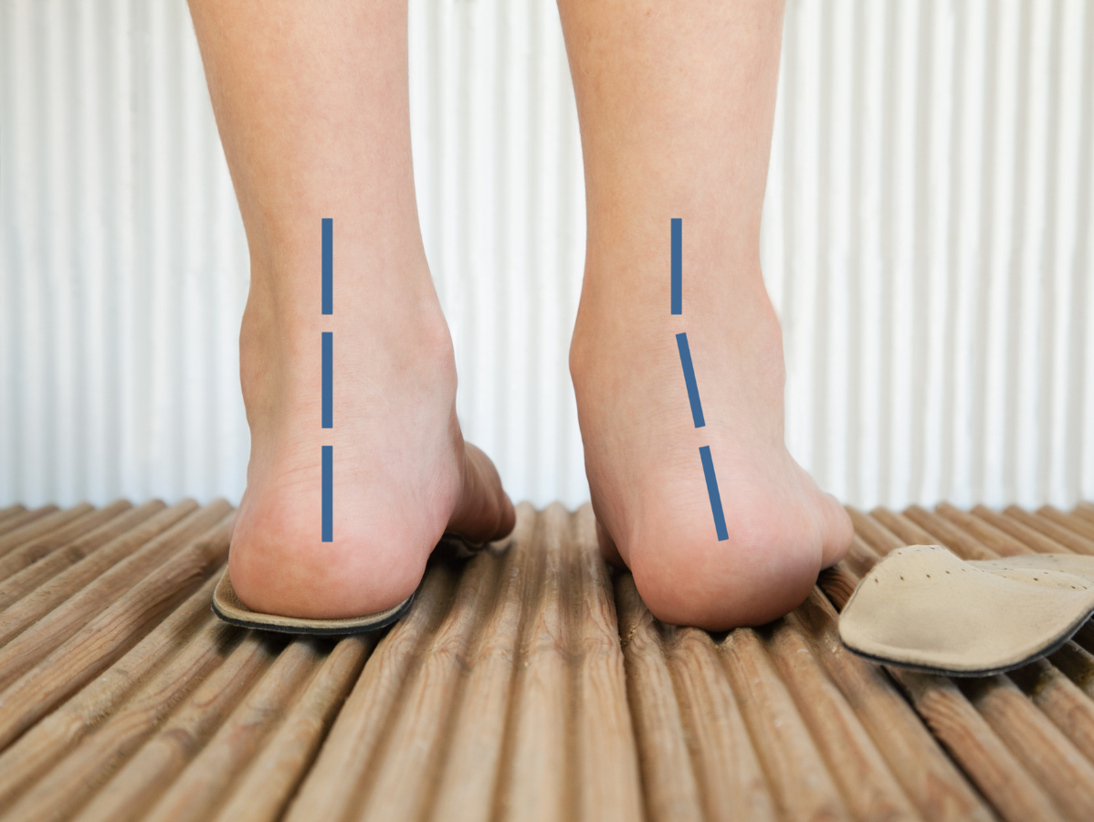Feet with one straight and one angled blue line, illustrating the effect of arch support.