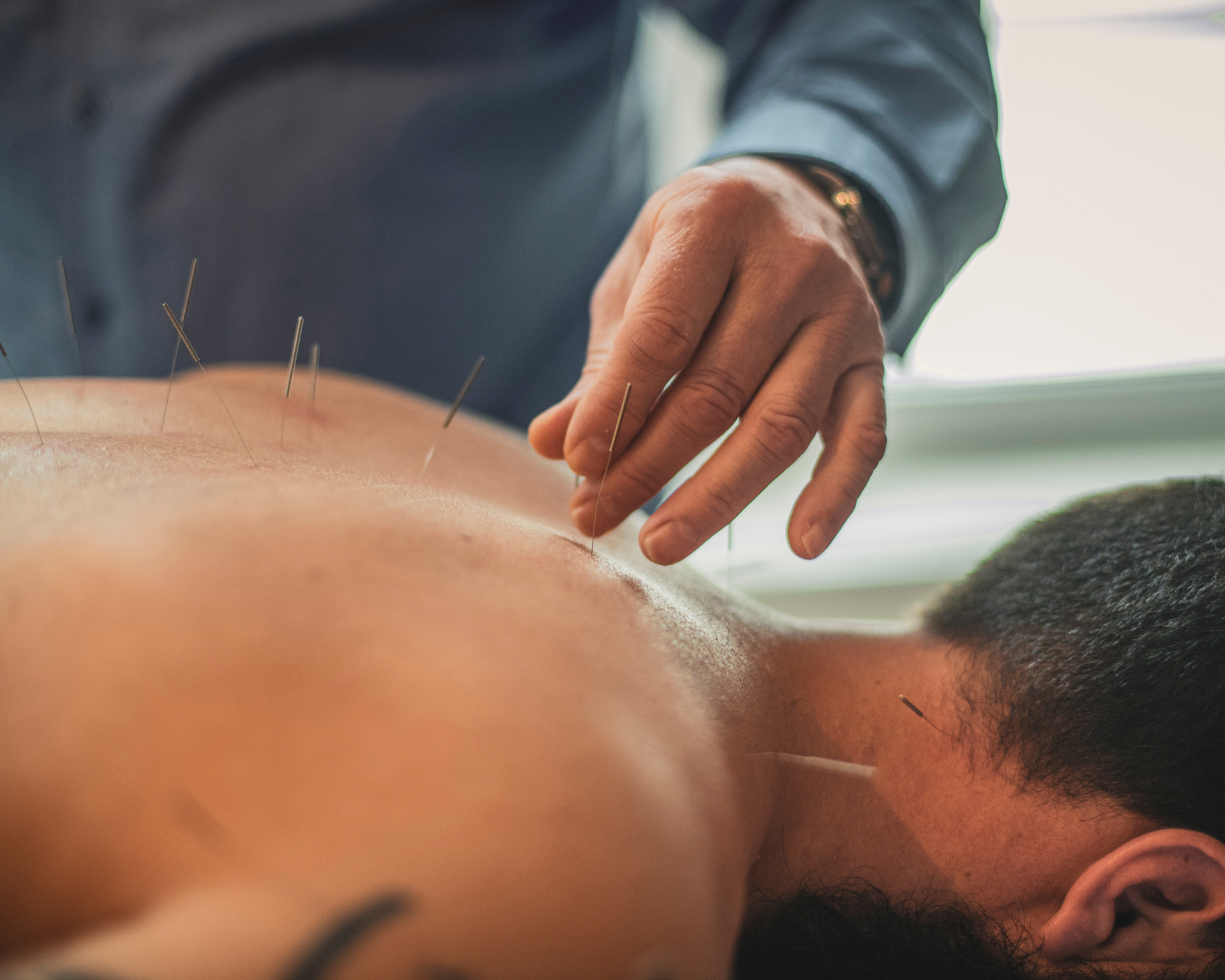 Raleigh Dry Needling Acupuncture