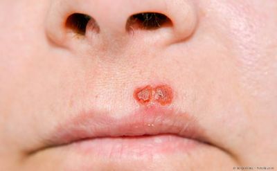 Laser gegen Lippen-Herpes und Aphthen