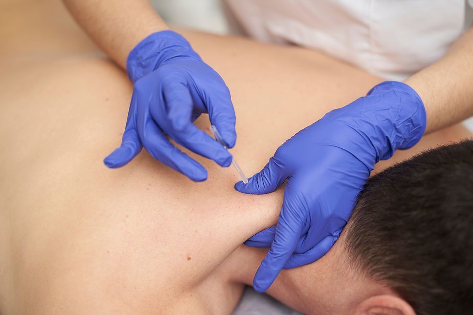 A man is getting an acupuncture treatment on his back.