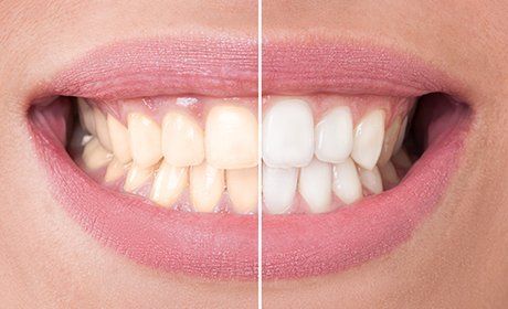 Teeth whitening services