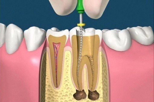 Trattamenti endodontici
