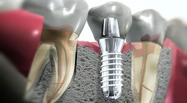 Installazione di impianti dentali