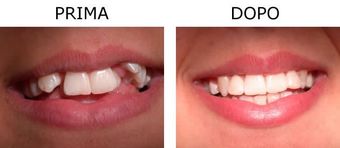 Denti prima e dopo trattamento ortodontico