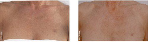 A before and after photo of a man 's chest.