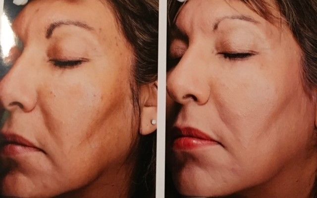 A before and after photo of a woman 's face