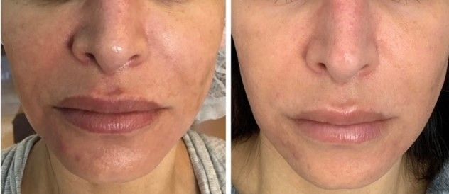 A before and after photo of a woman 's face.