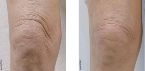 A before and after picture of a woman 's knee.