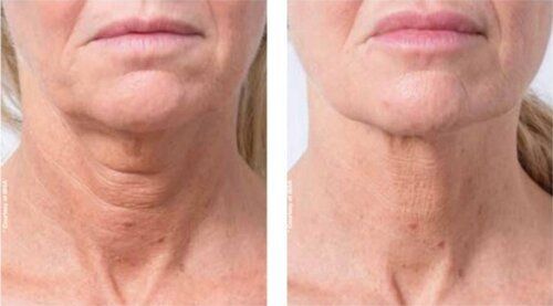A before and after photo of a woman 's neck and face.