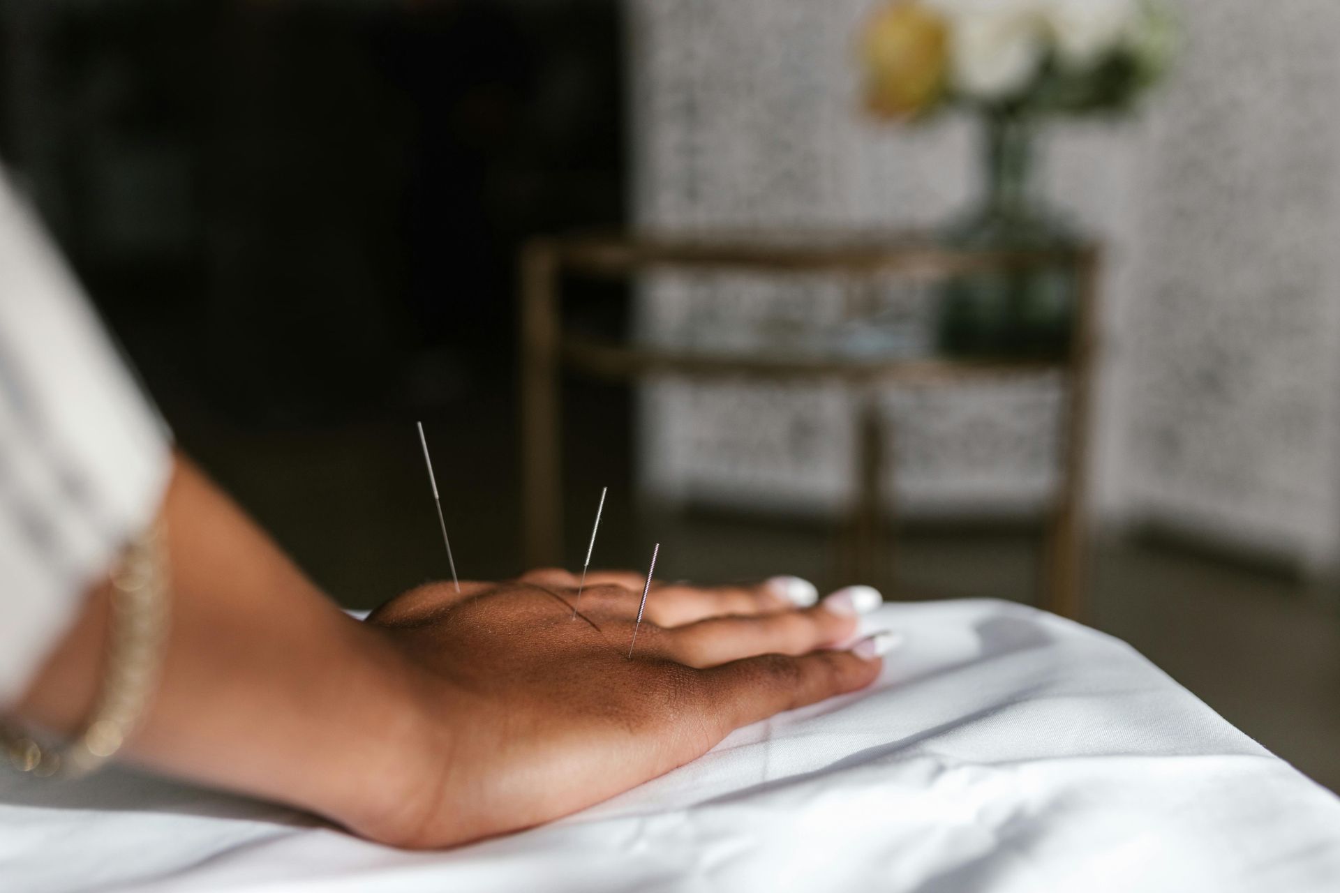 A woman is getting acupuncture on her hand.