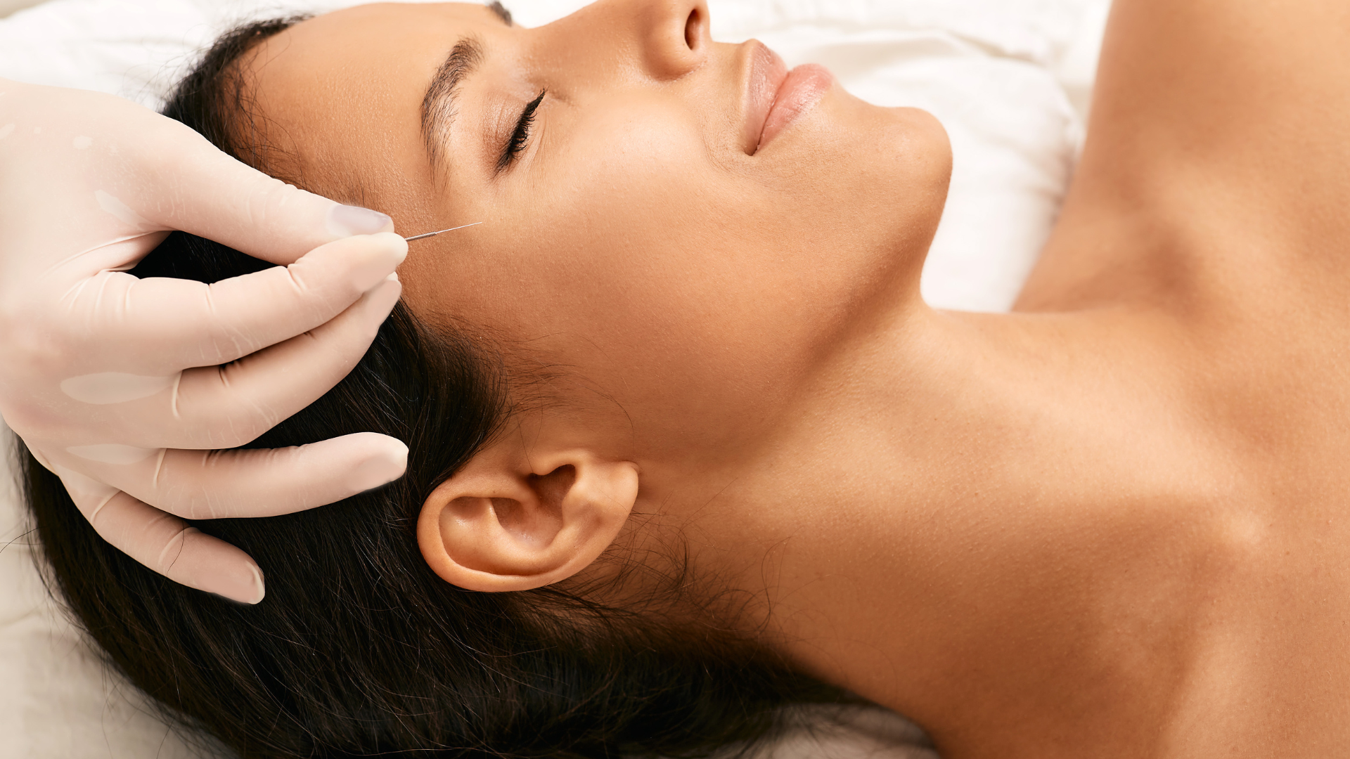 A woman is getting an acupuncture treatment on her head.