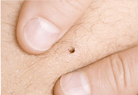 A person is holding a tick on their leg.