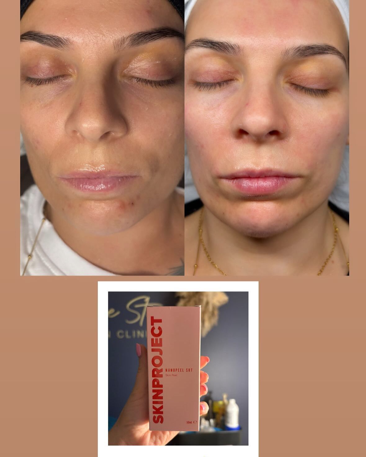 A Before and After photo for a skin peel