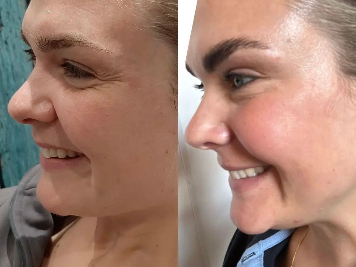 A before and after photo of anti wrinkle treatment for crows feet