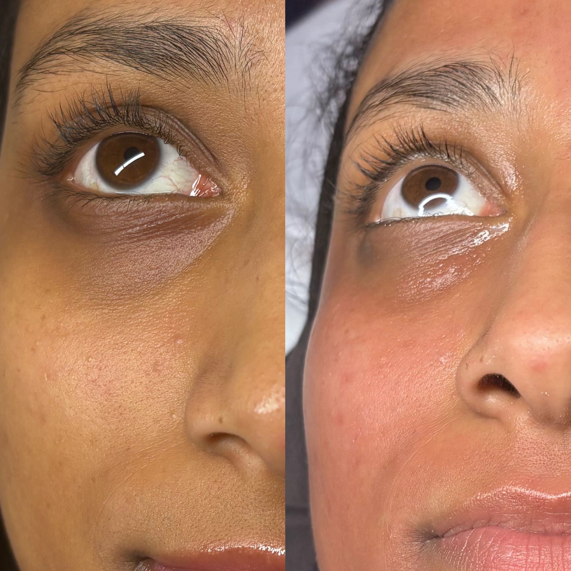 A before and after photo of Lumi Eyes 