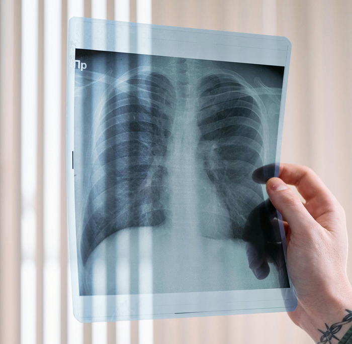 Person holding an X-ray of lungs. In front of a light-colored, vertical-striped background.