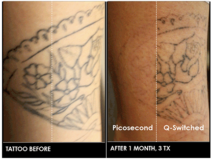 Tattoo Removal | Aluna Cosmetic Laser & Vein Surgery | Dr. Massoudi