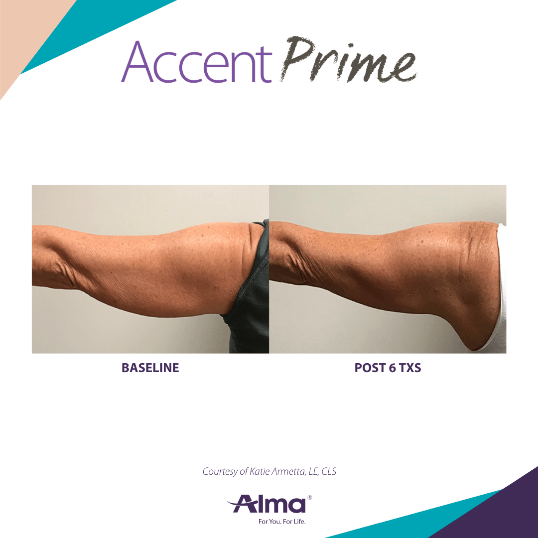 Accent Prime Body Contouring Before & After