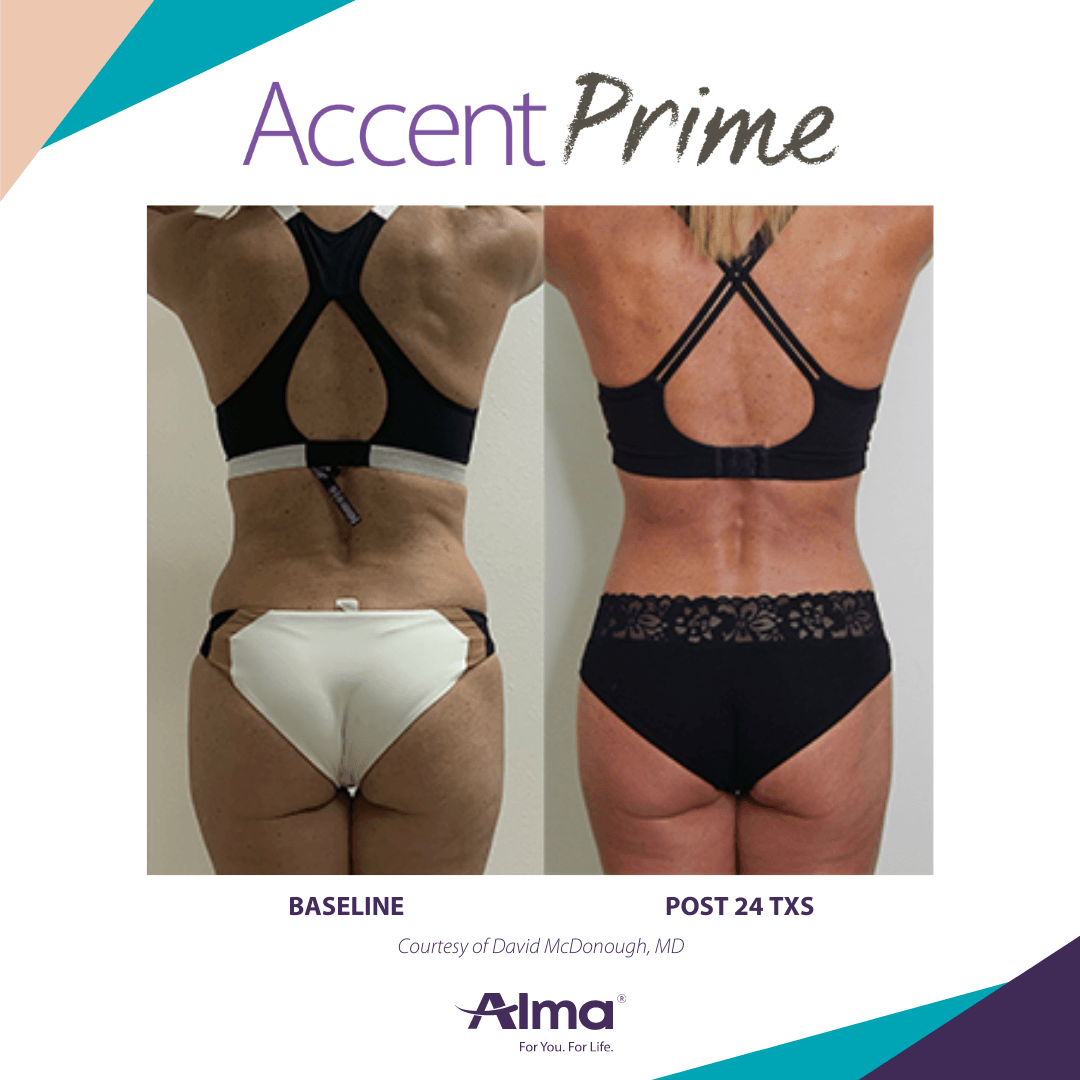 Accent Prime Body Contouring Before & After