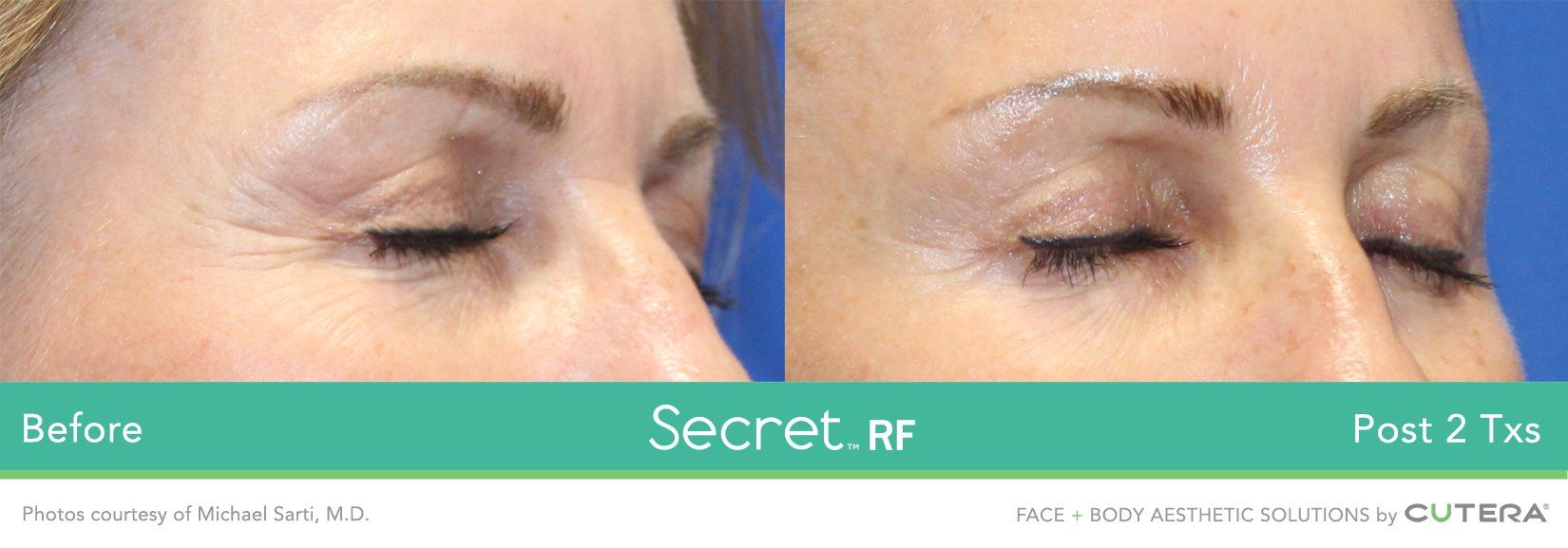 Secret RF Before and After