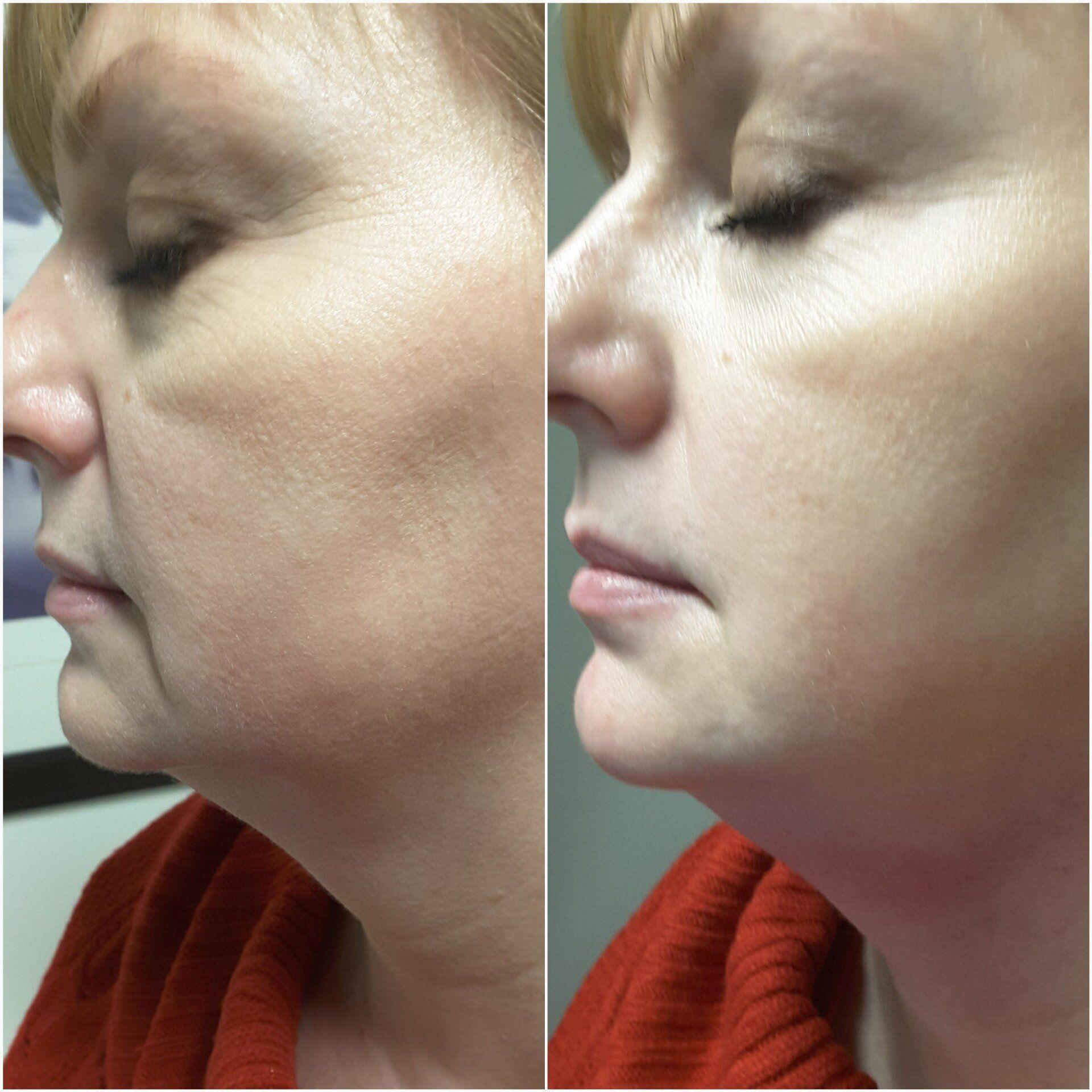 Sublime Before and After Skin Tightening
