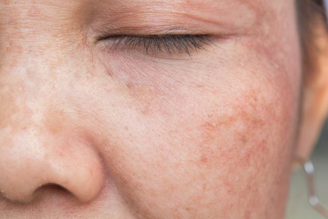 Dark spots on face: Know what are the causes, treatment and more – India TV