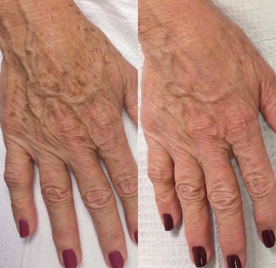 Hyperpigmentation hands. Before and After