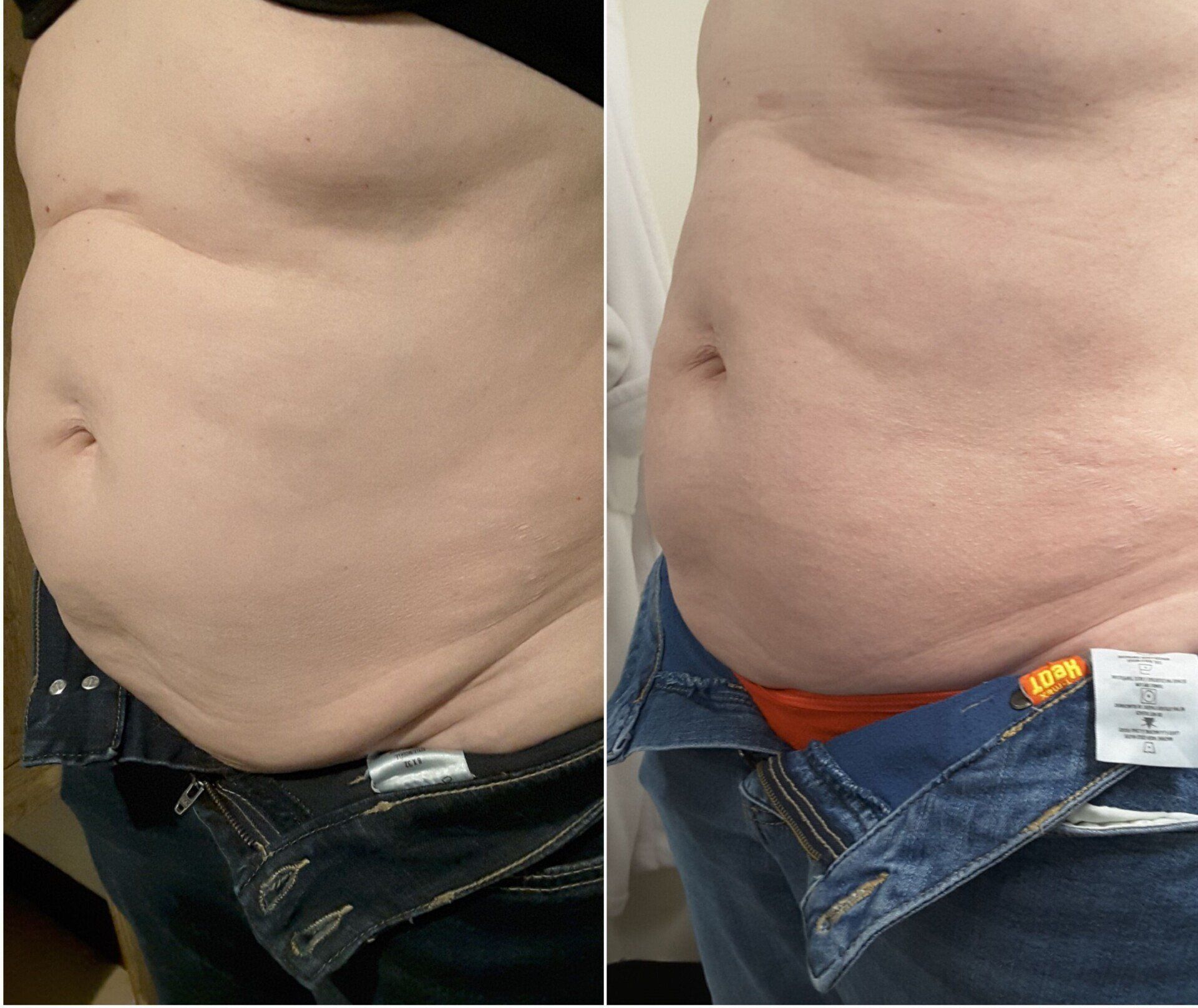 UltraShape Power Before and After