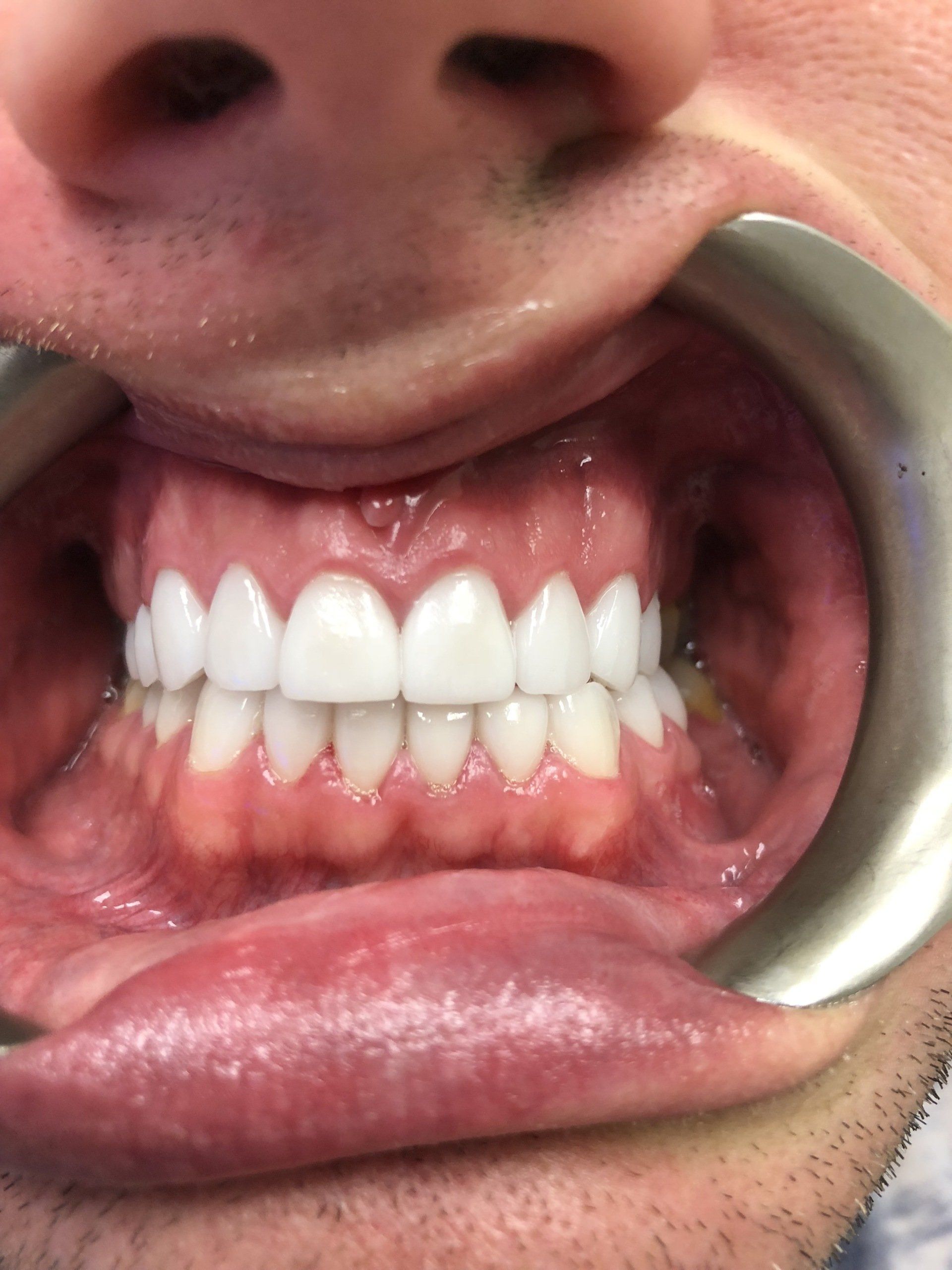 Veneers Miami FL Porcelain Veneer Miami Cost Near Me