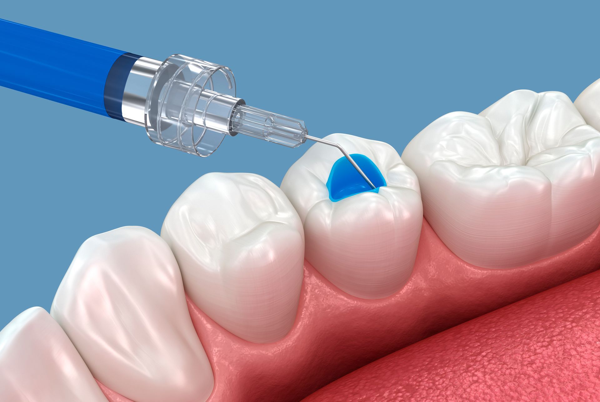 Dental filling procedure: syringe injecting blue material into a tooth cavity.