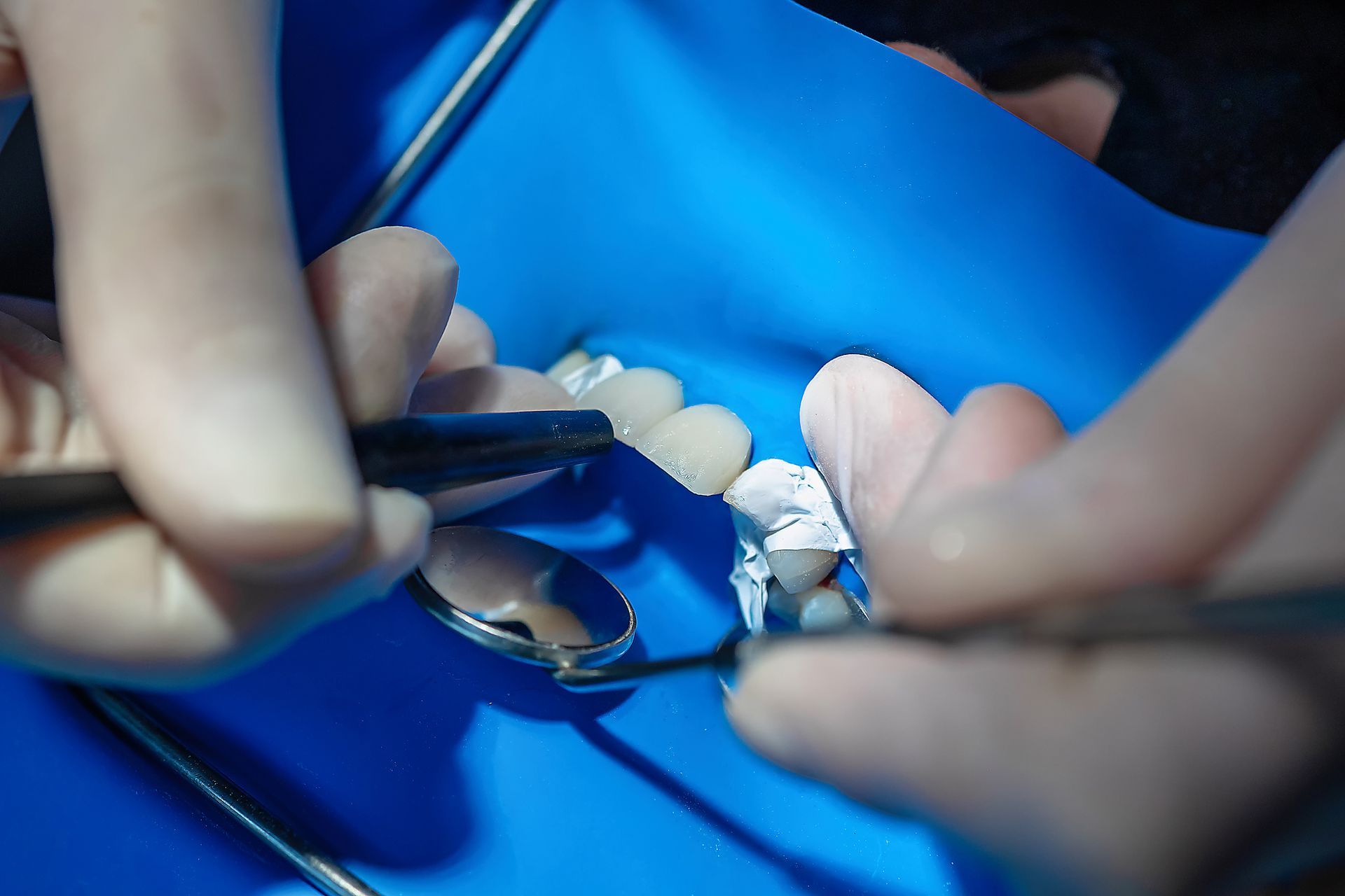 Dentist working on teeth, using tools and mirror, patient's mouth isolated with blue dental dam.