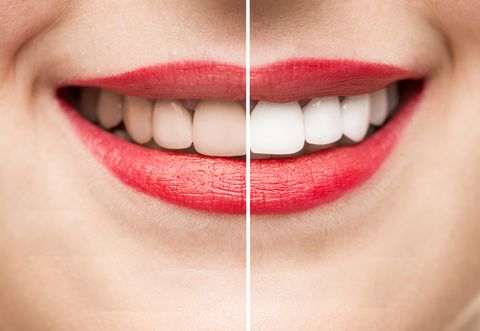 Family Dentist — Before and After of Teeth Cleaning in Richlands, NC