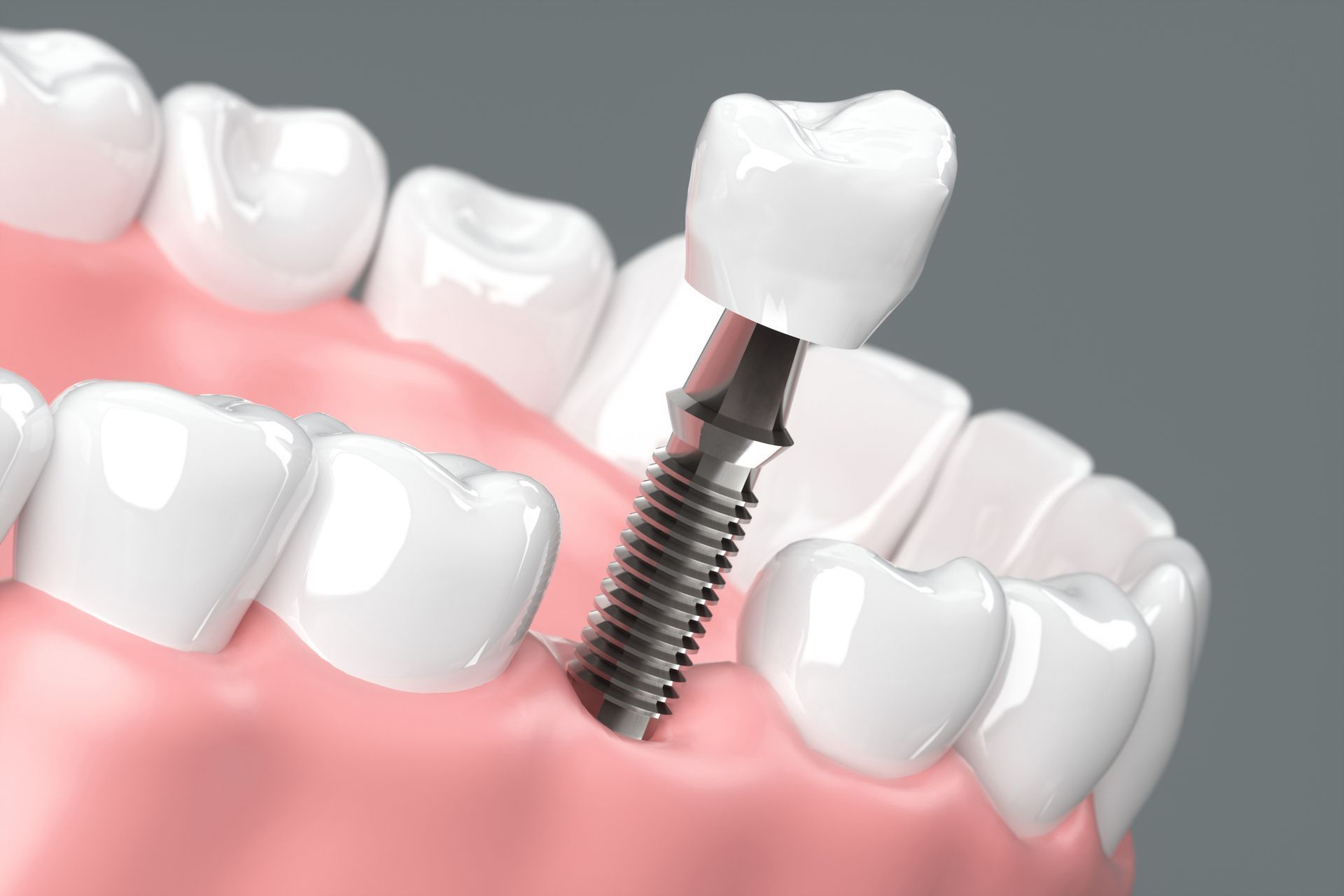 Teeth Check-up — Melbourne, VIC — Ladakis Dental