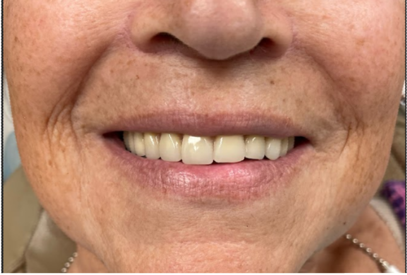 A close up of a woman 's smile with white teeth.