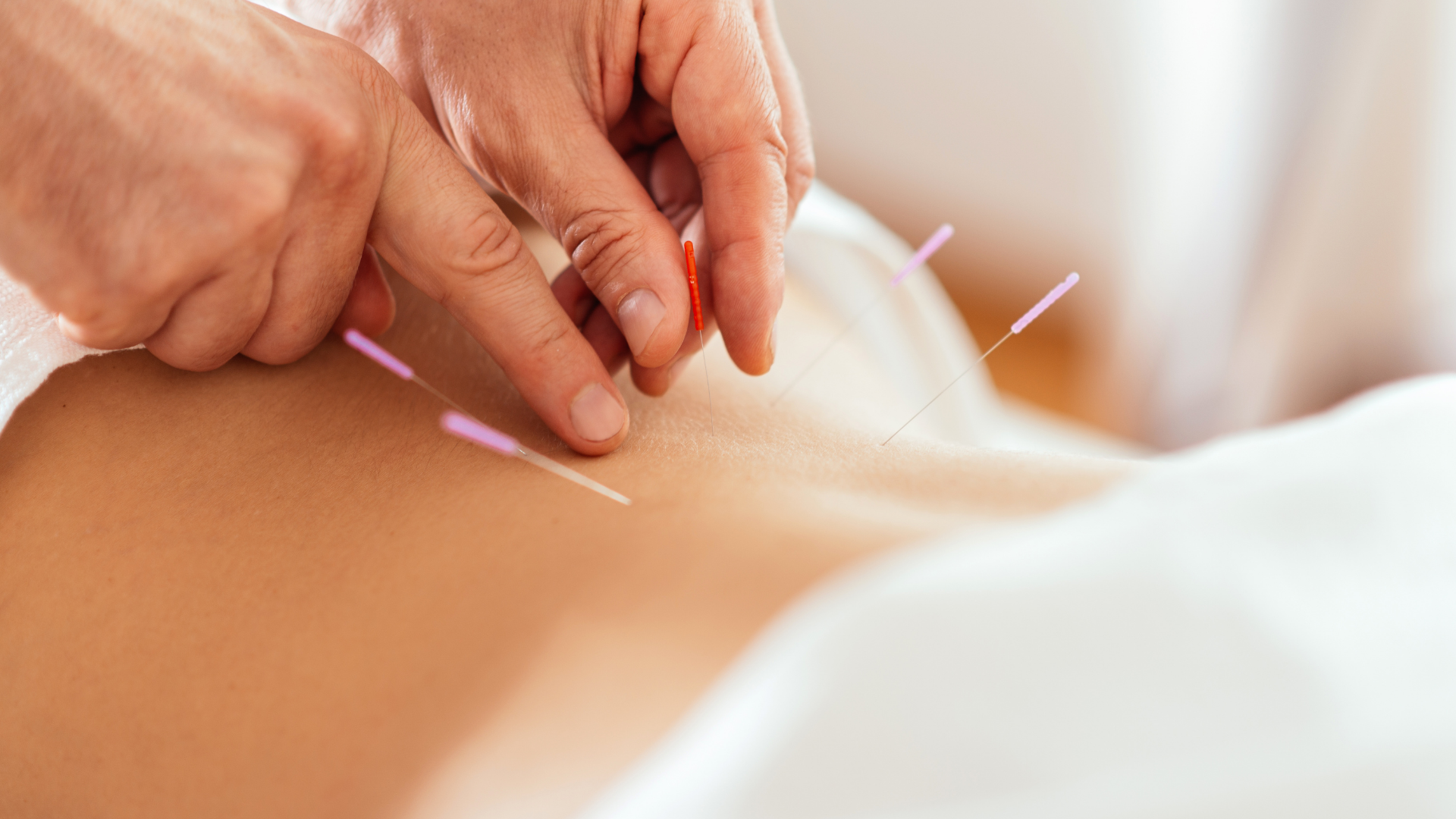 Experience the healing power of acupuncture with soothing, expert care. Unlock balance and wellness 